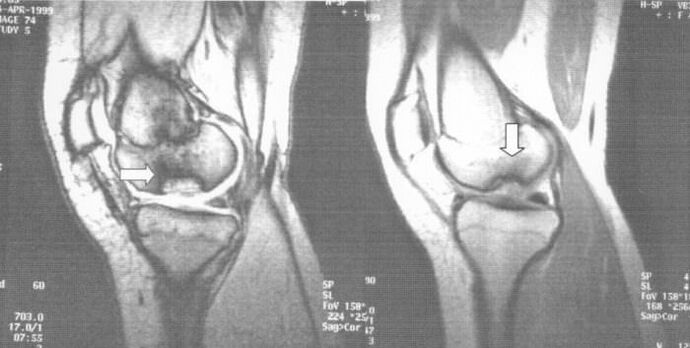 ακτινογραφία της οστεοχονδρωσίας στην άρθρωση του γόνατος